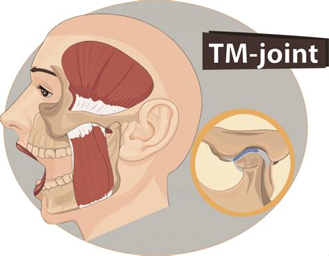 Tmj Dysfunction How Your Jaw Works And How Its Treated When It Doesnt