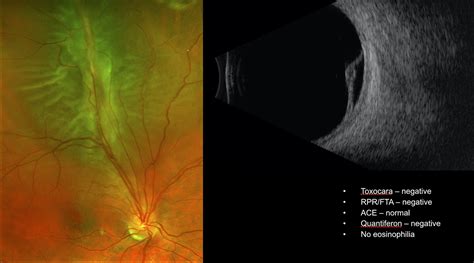 Tractional Retinal Detachment Oct