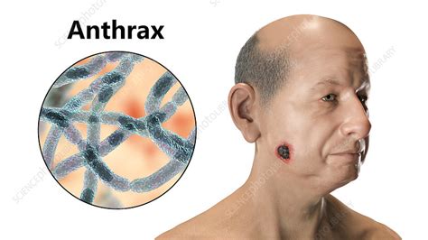 Cutaneous anthrax, illustration - Stock Image - F033/4707 - Science Photo Library