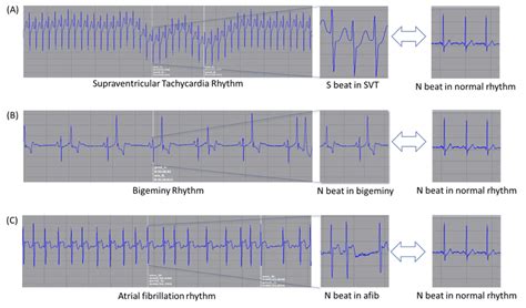 Beats in rhythms with different shapes. SVT: supraventricular ...