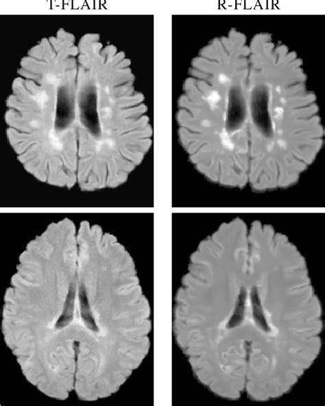 Random Forest FLAIR Reconstruction From T1 T2 And PD Weighted MRI