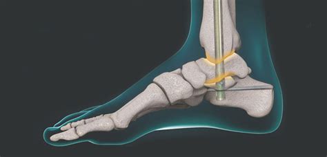 New Data Released for NiTiNOL Implants in TTC Fusion Patients ...