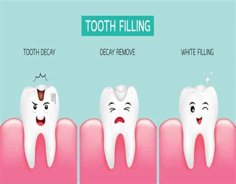 Cavity Filling Costs In 2023 With And Without Insurance