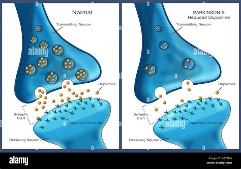 Illustration De L étiquette De Faibles Niveaux D Un Neurotransmetteur La Dopamine Dans Un