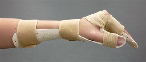 Resting Splint Made Out Of Orfit Eco Mafra And Microgrip Strapping