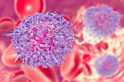 Lisocabtagene Maraleucel Meets Its Primary Endpoint Of Complete