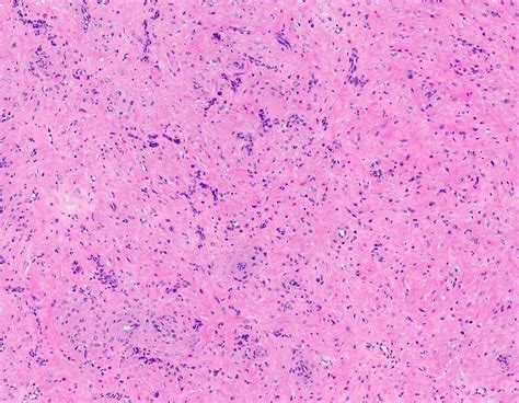 Pathology Outlines Angioleiomyoma