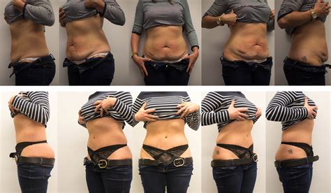 Tummy Tuck Bristol Abdominoplasty By Anthony Macquillan