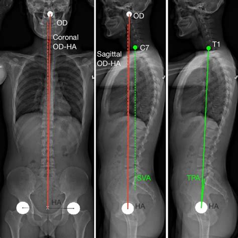 Anteroposterior And Lateral X Rays Of An Asymptomatic Adult