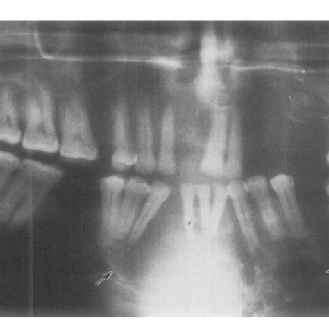 Panoramic Radiograph Shows Multilocular Radiolucency In Mandible Arrow