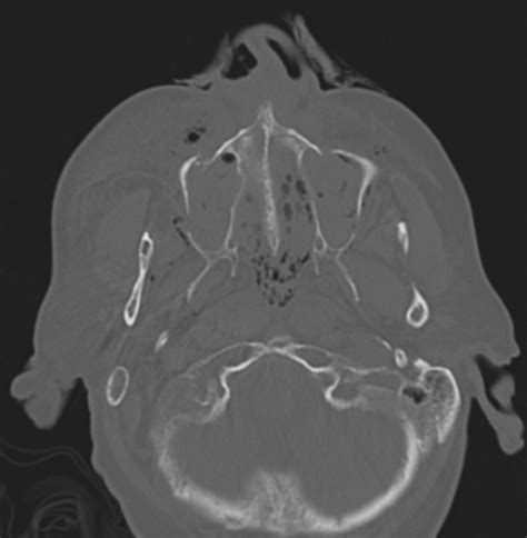 Le Fort Type Facial Fractures Image Radiopaedia Org