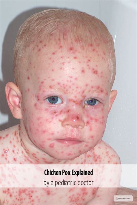 Chicken Pox in Children, Snotty Noses