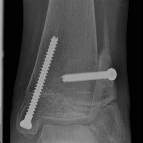 Anteroposterior radiograph showing a tibiofibular synostosis with screw ...