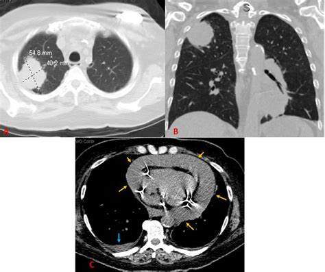 Fluid Around Lung Ct Scan