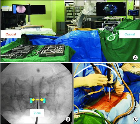 A Setup For Unilateral Biportal Endoscopic Decompression Surgery B