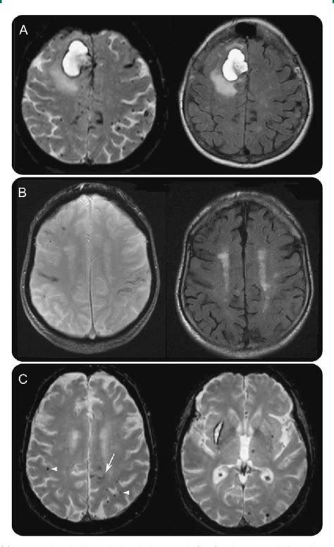 Figure From Prevalence And Mechanisms Of Cortical Superficial