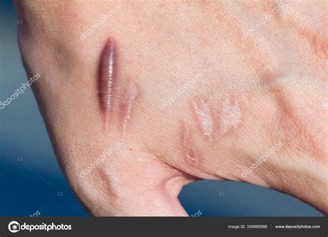 Keloid Scar Hypertrophic Scar Man Hand Skin Accident Keloidal Scar