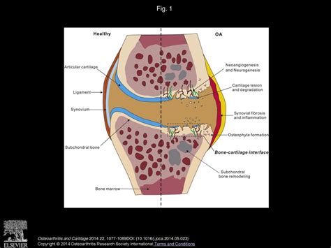 Bonecartilage Interface Crosstalk In Osteoarthritis Potential