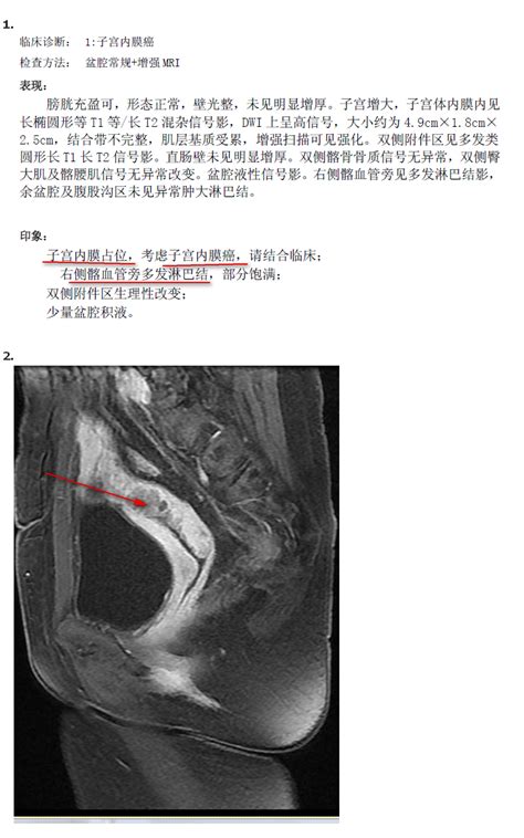 子宫内膜癌一例