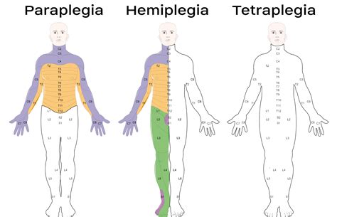 Tetraplegia Cause Symptoms Treatment Exercise