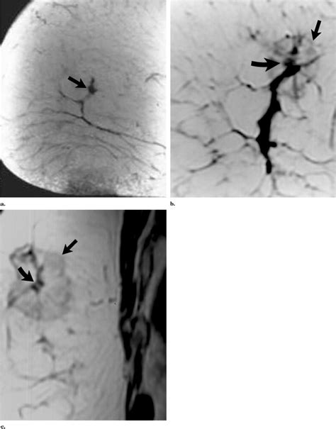 Feasibility Of Magnetic Resonance Imaging Guided Focused Ultrasound