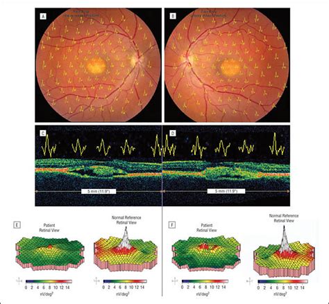 Localization Of Multifocal Electroretinogram Abnormalities To The