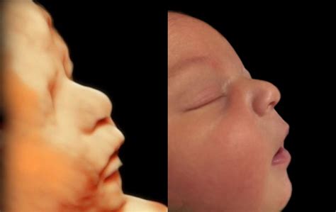 Before After Photo Gallery D Hdlive D D Hd Ultrasound Virginia