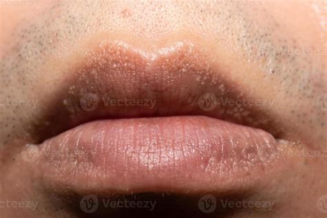 Primer Plano De Las Manchas De Fordyce En Los Labios Foto De