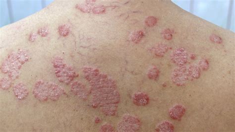 Psoriasis Rash: What It Looks Like and How to Deal - Greatist pro