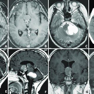 Preoperative Axial A And B Sagittal E And F And Coronal G And H