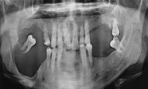 Orthopantomogram Opg Showing A Well Defi Ned Lytic Lesion Causing