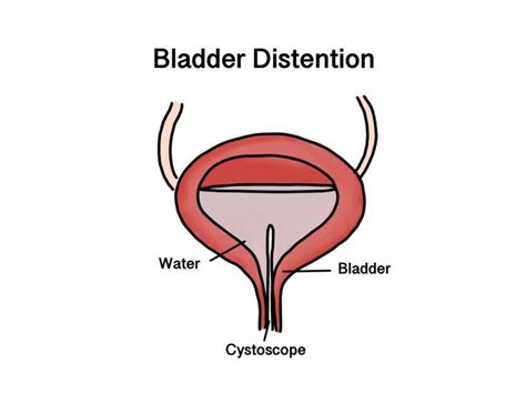 Interstitial Cystitis Treatment In Singapore Aare Urocare Dr Fiona