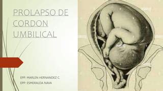 PROLAPSO DE CORDON UMBILICAL Pptx