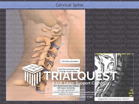 Cervical Spine Trial Exhibits Inc