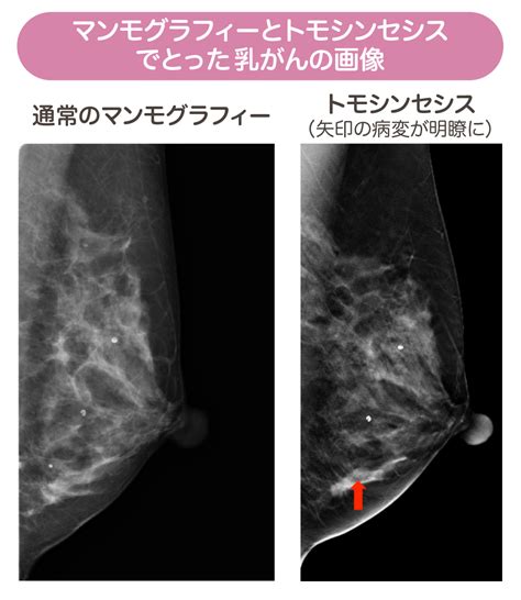 第2回 乳がんの早期発見、マンモグラフィーを柱に検診、検査から診断が確定するまで｜こちら診察室｜時事メディカル｜時事通信の医療ニュースサイト