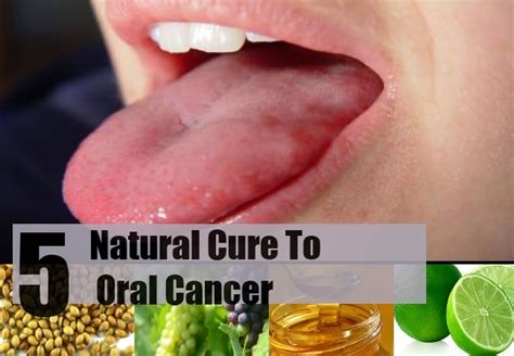 Top 5 Natural Cures For Oral Cancer ~ Mzizi Mkavu