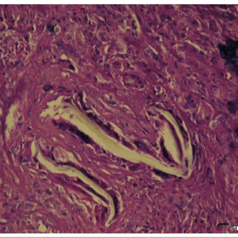 Polyethylene Particle Inside Giant Cell In Periprosthetic Tissue Under