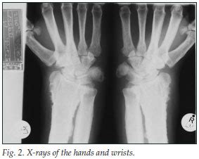 Osteoarthropathy, Primary Hypertrophic; Pachydermoperiostosis