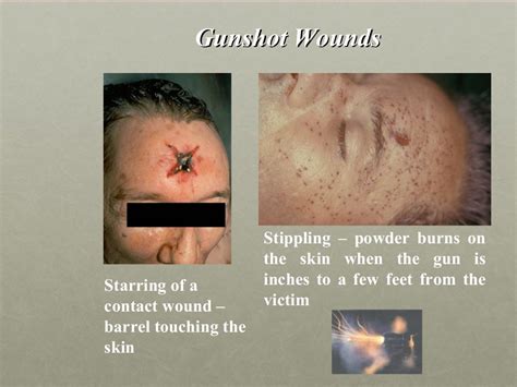 Wounds In Forensic Medicine