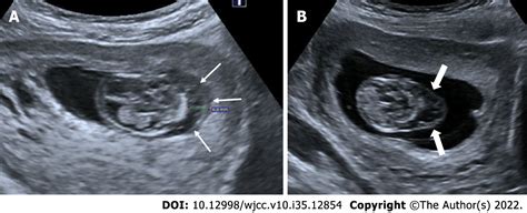 Antenatal Imaging A Pictorial Review