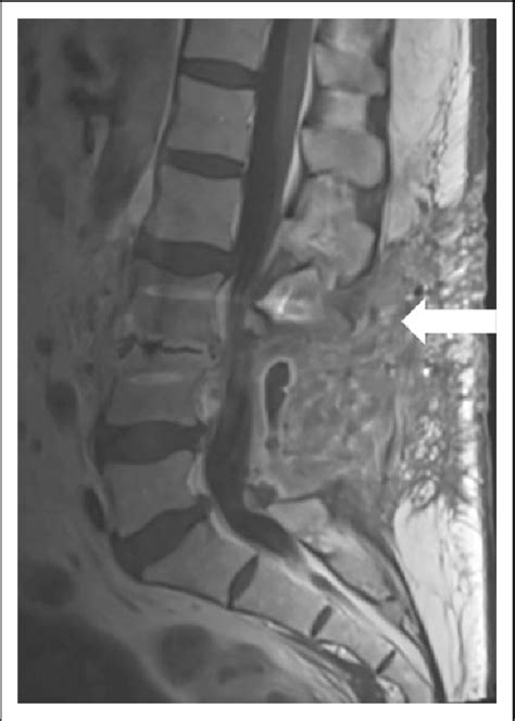 Sagittal T1 Postcontrast Magnetic Resonance Imaging Scan Of The Lumbar Download Scientific