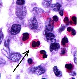 Eosinophilic Granuloma Pathology Orthobullets