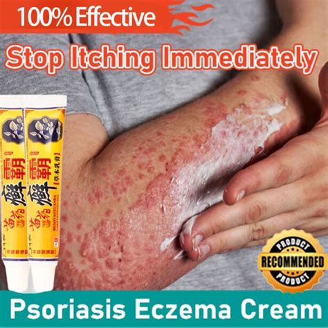 Herbal Ointments For Skin Deases Eczema Treatment Cream Anti Fungal