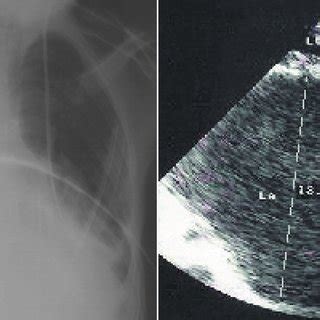 Chest X Ray Figure 2 Preoperative Transthoracic Echocardiography Left