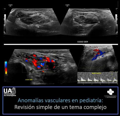 Anomal As Vasculares En Pediatr A Revisi N Simple De Un Tema Complejo