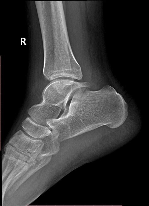 Posterior Ankle Impingement Mri