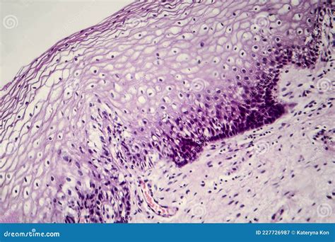 Cancer Of Cervix Light Micrograph Of Cervical Biopsy Photo Under