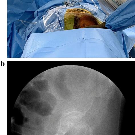 A Positioning For Iliac Oblique View With The Image Intensifier Rolled