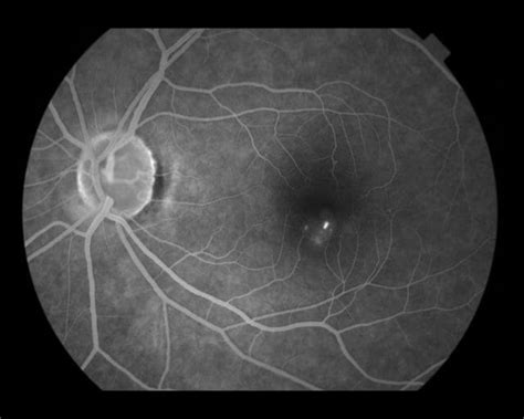 Severe Diabetic Macular Edema Associated With Poor Visual Acuity Other Complications