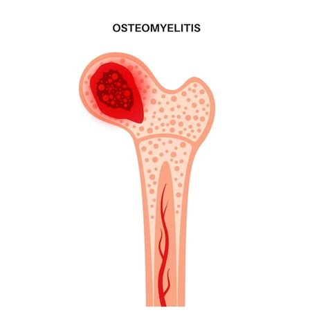 Premium Vector Osteomyelitis Disease Infected Hip Pain And Overlying